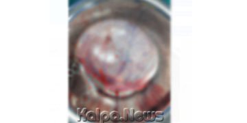 ಶಸ್ತ್ರಚಿಕಿತ್ಸೆ ಮೂಲಕ ಯುವತಿ ಹೊಟ್ಟೆಯಿಂದ 8 ಕೆಜಿ ತೂಕದ ಗೆಡ್ಡೆ ಹೊರತೆಗೆದ ಸಾಗರ ವೈದ್ಯರು