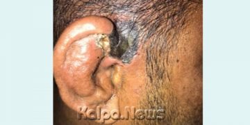 ದೇಶದಲ್ಲೇ ಮೊಟ್ಟಮೊದಲ ಬಾರಿಗೆ ಚಿತ್ರದುರ್ಗದಲ್ಲಿ ಪತ್ತೆಯಾಯ್ತು ಚರ್ಮದಲ್ಲಿ ಬ್ಲಾಕ್ ಫಂಗಸ್