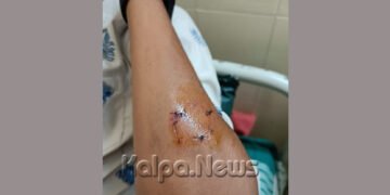 ವಿದ್ಯಾರ್ಥಿಯ ಕೈಕಚ್ಚಿದ ಉಪನ್ಯಾಸಕ ಯಾಕೆ ಗೊತ್ತಾ? ಇಲ್ಲಿದೆ ಮಾಹಿತಿ