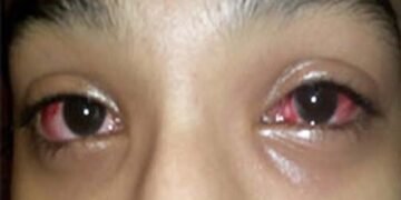 ಕಂಜಕ್ಟವೈಟೀಸ್ ಎಂದರೇನು, ಕಣ್ಣಿನ ಸೋಂಕಿತರು ಅನುಸರಿಸಬೇಕಾದ ಕ್ರಮಗಳೇನು? ಇಲ್ಲಿದೆ ಮಾಹಿತಿ