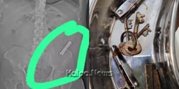 ಹೊಟ್ಟೆ ನೋವೆಂದು ಆಸ್ಪತ್ರೆಗೆ ಬಂದ ಯುವಕ | ಎಕ್ಸ್’ರೇ ನೋಡಿ ಬಚ್ಚಿಬಿದ್ದ ವೈದ್ಯರು | ಇಷ್ಟಕ್ಕೂ ಏನೆಲ್ಲಾ ಇತ್ತು?