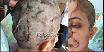 ಸಾಕು ನಾಯಿ ಭೀಕರ ದಾಳಿ | ಗಾಯಗೊಂಡ ಮಹಿಳೆಗೆ 50ಕ್ಕೂ ಹೆಚ್ಚು ಹೊಲಿಗೆ