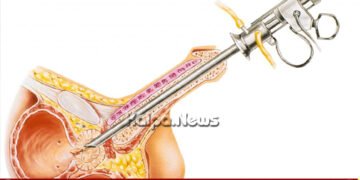 ಸಹ್ಯಾದ್ರಿ ನಾರಾಯಣ ಆಸ್ಪತ್ರೆಯಿಂದ ಮತ್ತೊಂದು ಮೈಲಿಗಲ್ಲು | 1,000 ಪ್ರಾಸ್ಟೇಟ್ ಸರ್ಜರಿ ಯಶಸ್ವಿ ಪೂರ್ಣ